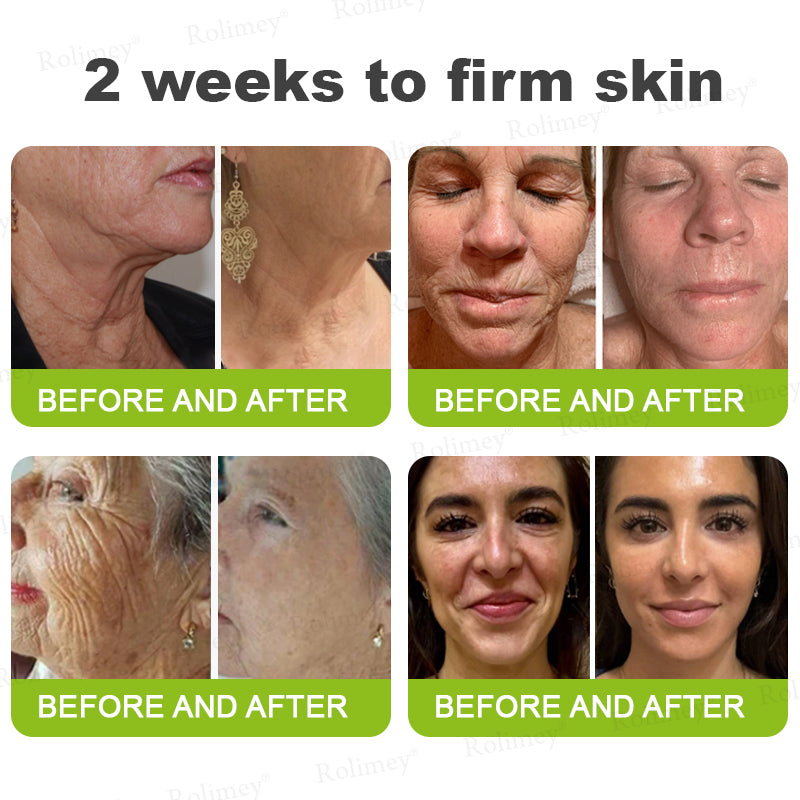 💖🎊🎐Made and shipped from the UK 💫Rolimey® Botox & Vita-A Retinol Shot Wrinkle-Lift Tightening cream - Last Day Promotion 70% OFF
