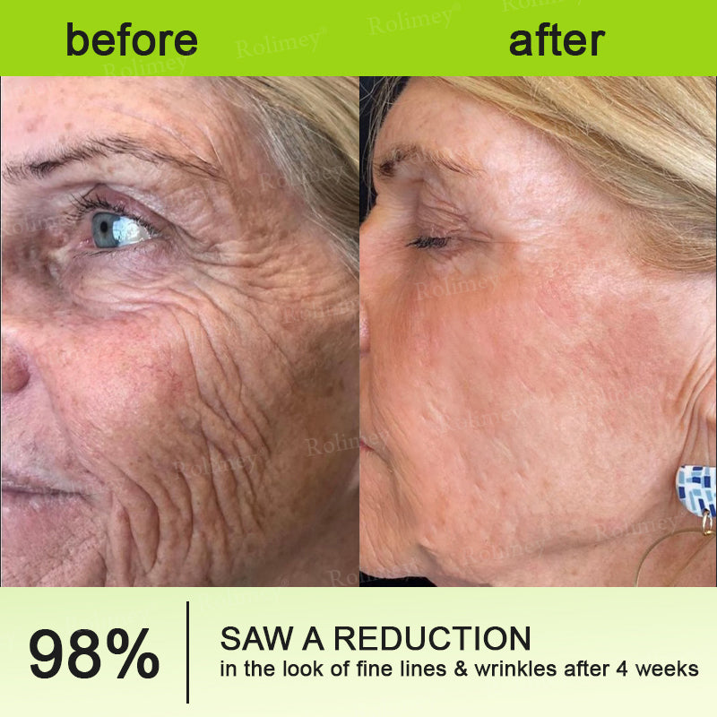 💖🎊🎐Made and shipped from the UK 💫Rolimey® Botox & Vita-A Retinol Shot Wrinkle-Lift Tightening cream - Last Day Promotion 70% OFF